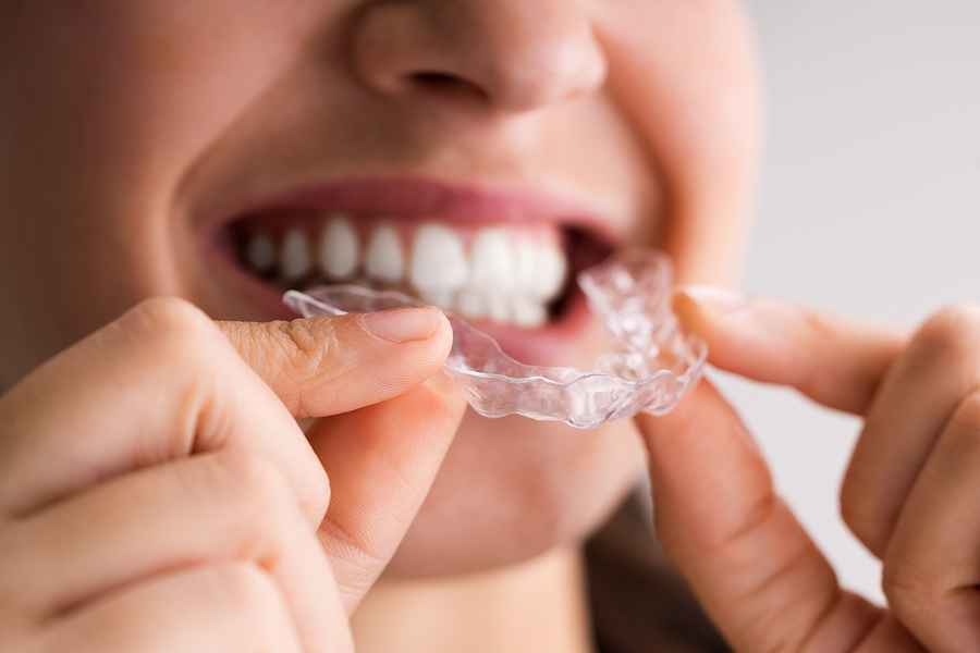 5 Questions to Ask Before Choosing a Clear Aligner Provider